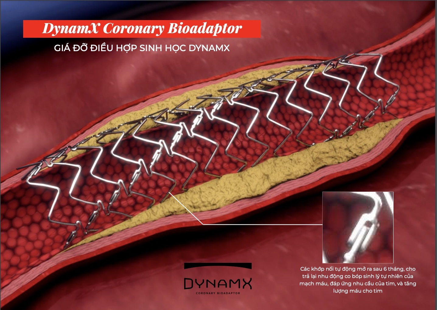 Elixir Medical’s Dynamx Bioadaptor returns strong results