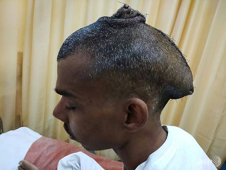indian surgeons remove heaviest recorded brain tumour