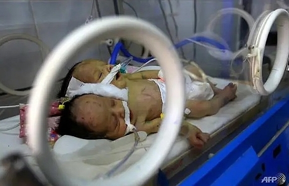 Yemeni conjoined twins die in blockaded Sanaa