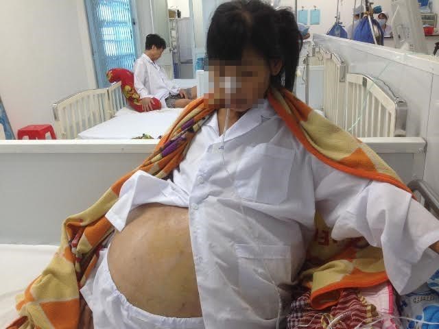 Vietnamese woman has 32kg ovarian tumor