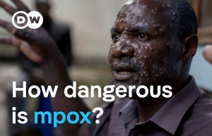 Mpox killed 548 people in DR Congo since start of 2024