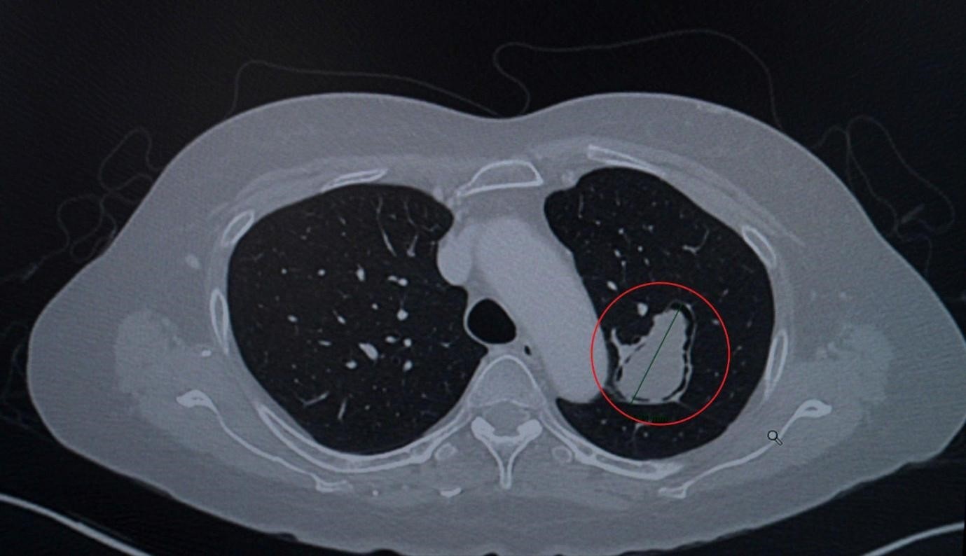 Robotic surgery treats high-risk pulmonary mycosis
