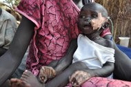 malnutrition puts 450m children at risk of stunting