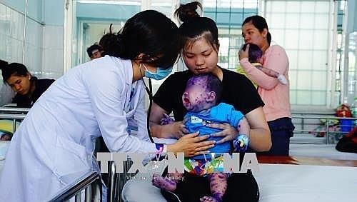 chickenpox cases on the rise in south