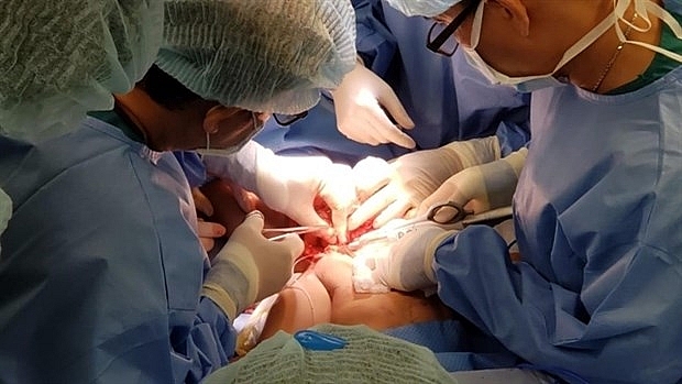hcm citys doctors separate conjoined twins