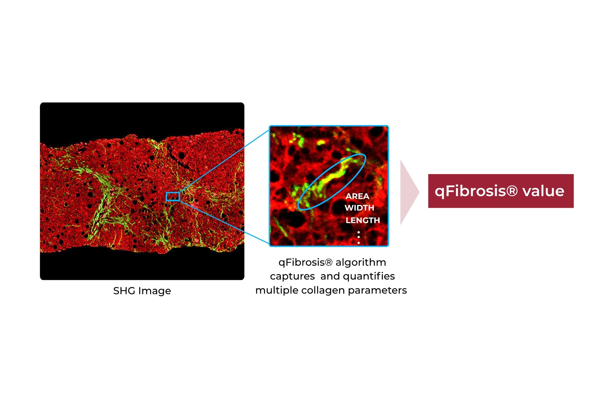 Quantifying multiple collagen parameters with qFibrosis®