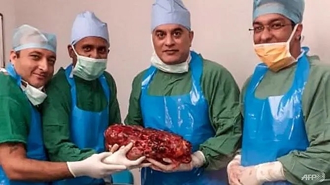 indian doctors remove giant 74kg kidney from man